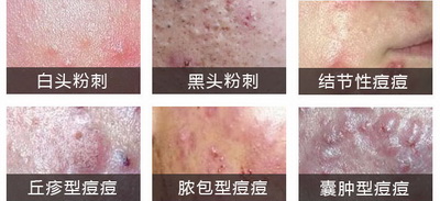 青春痘常见症状类型