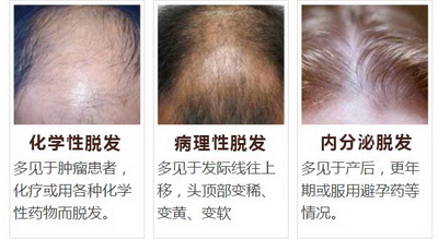 6种常见脱发类型