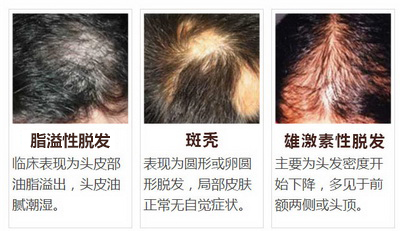 6种常见脱发类型