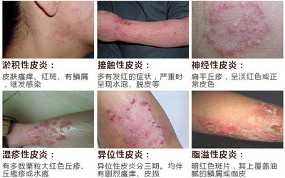 6种常见皮炎症状类型