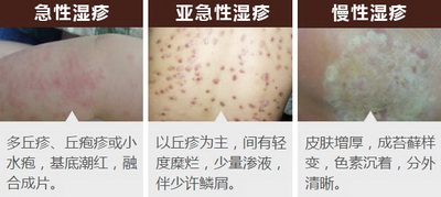 湿疹的症状类型有哪几种