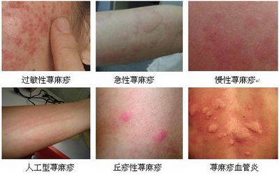 荨麻疹发病具体有哪些类型
